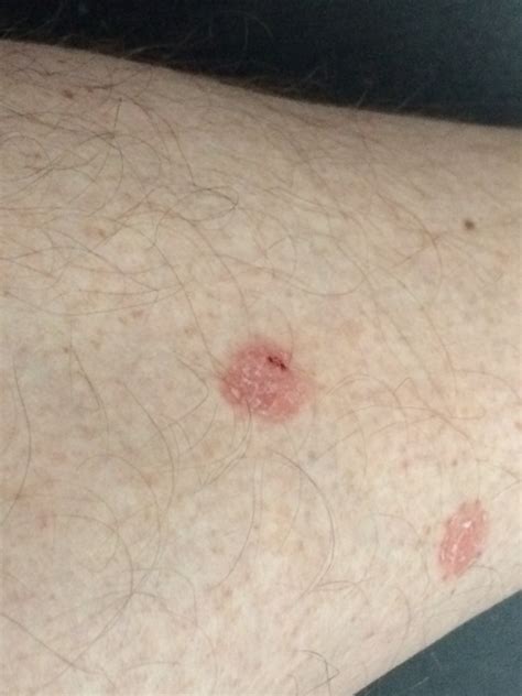 red blotches on legs